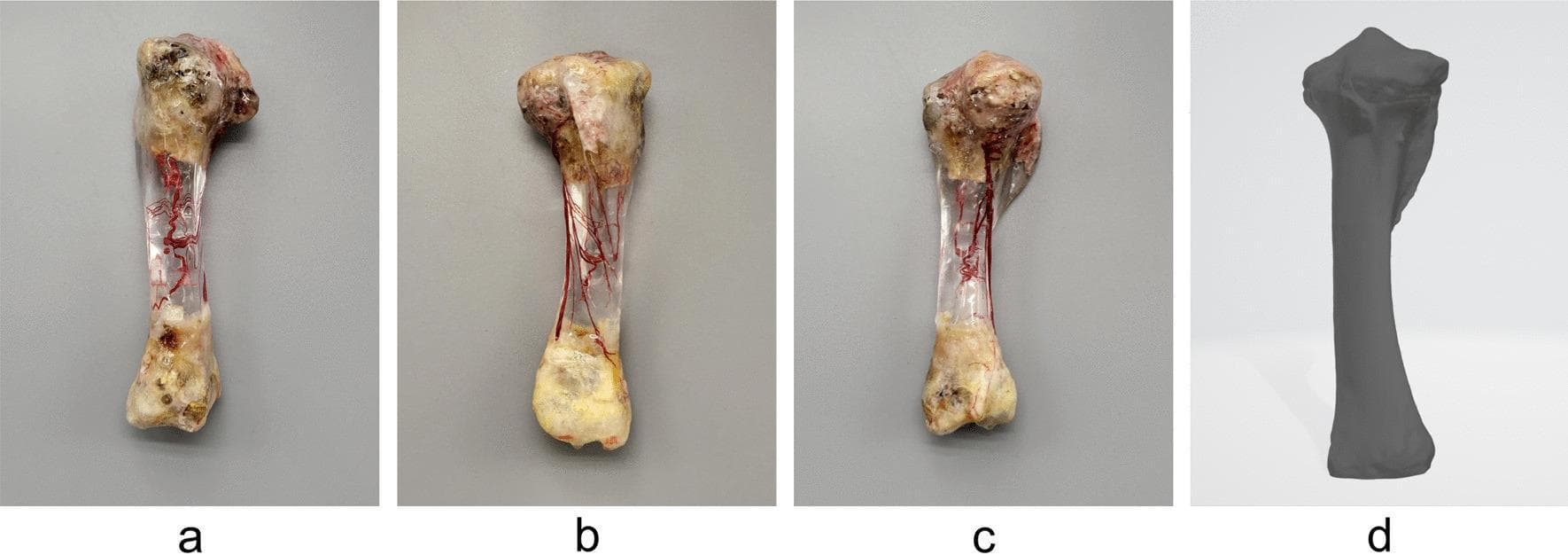 This figure showcases a human tibia specimen prepared using an advanced vascular casting and bone-clearing technique to demonstrate internal intraosseous blood supply. Figures a (rear view), b (side view), and c (front view) display the physical specimen where the cortical bone has been replaced with a transparent epoxy resin. Inside the clear diaphysis, the intraosseous vascular network is clearly visible, highlighted by a red casting agent. The network shows the primary nutrient artery entering the medullary cavity and bifurcating into ascending and descending medullary trunks with subsequent terminal branching toward the proximal and distal metaphyses. The arrangement reveals higher vessel density at the epiphyses compared to the mid-shaft. Figure d provides a complementary 3D digital model of the same tibia, illustrating the external anatomical landmarks and surface morphology used for resin mold construction. This anatomical demonstration is crucial for orthopedic surgical planning, particularly in understanding bone vascularization and nutrient foramen localization.