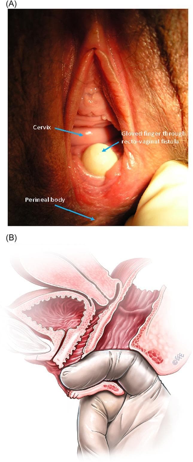 The image consists of two parts illustrating a low rectovaginal fistula (RVaF). Figure A is a clinical photograph of the perineal region showing a low-seated fistula located on the posterior vaginal wall, just proximal to the anus. A gloved finger is shown protruding through the fistula defect from the rectum into the vagina to demonstrate the abnormal communication. Key landmarks labeled include the cervix superiorly, the fistula site, and the perineal body inferiorly. Figure B is a corresponding sagittal anatomical diagram providing a schematic representation of the same condition. It illustrates the pelvic anatomy including the bladder, uterus, vagina, and rectum. The diagram highlights the fistula tract connecting the anterior wall of the rectum to the posterior vaginal wall. Similar to the photograph, it depicts a gloved finger passing through the anal canal and through the rectovaginal defect, reinforcing the diagnostic physical exam finding. This comparison is used in medical education to teach the clinical appearance and anatomical path of obstetric or acquired rectovaginal fistulas.