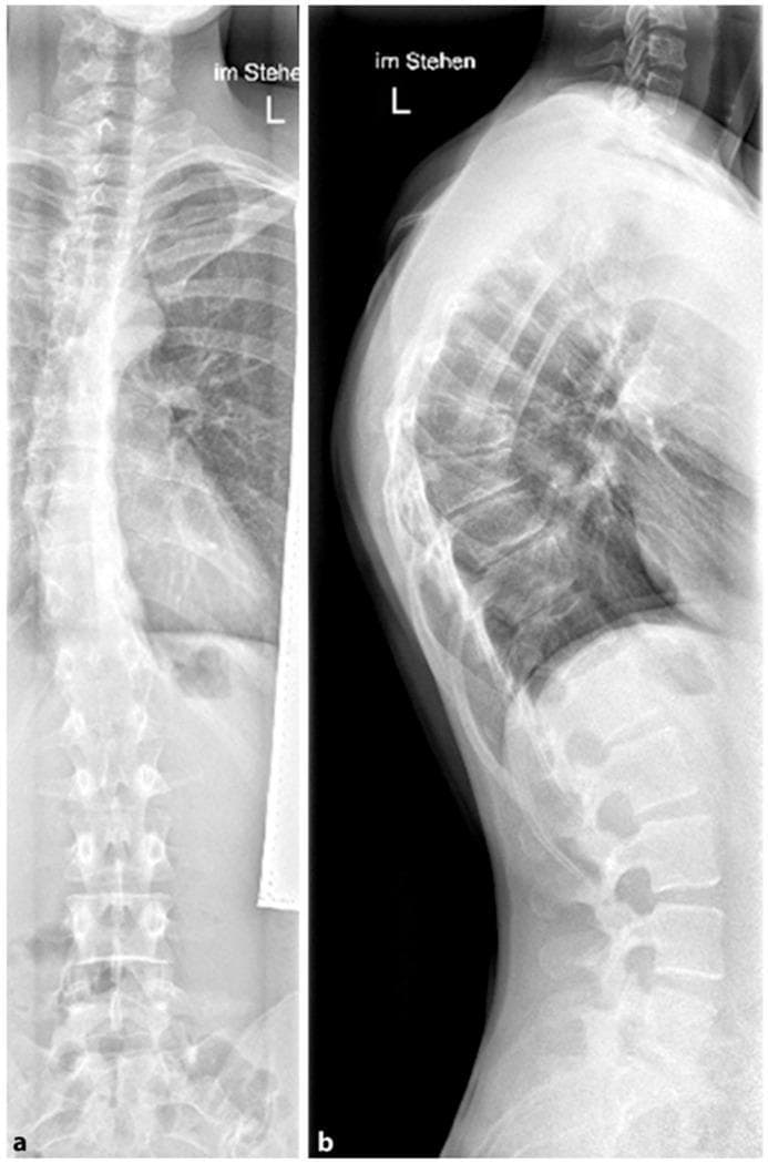 This diagnostic image displays a dual-view radiograph of the human spine, featuring a posterior-anterior (PA) view (a) and a lateral view (b) from a standing patient. The imaging demonstrates classic findings of Scheuermann's disease localized to the thoracic spine. In the lateral view, there is prominent hyperkyphosis characterized by multi-segmental anterior wedging of the thoracic vertebral bodies and irregular vertebral endplates. The PA view reveals a concomitant mild thoracic scoliosis, evidenced by a subtle lateral deviation of the spine from the vertical midline. Key anatomical landmarks include the cervical-thoracic junction, the rib cage, and the lumbar vertebrae. This clinical presentation is typical of adolescent spinal deformities, illustrating the structural changes—specifically anterior vertebral body wedging and endplate irregularity—that differentiate structural kyphosis from postural rounding. The image is a primary resource for medical education regarding the diagnostic imaging of pediatric orthopedic spinal conditions.
