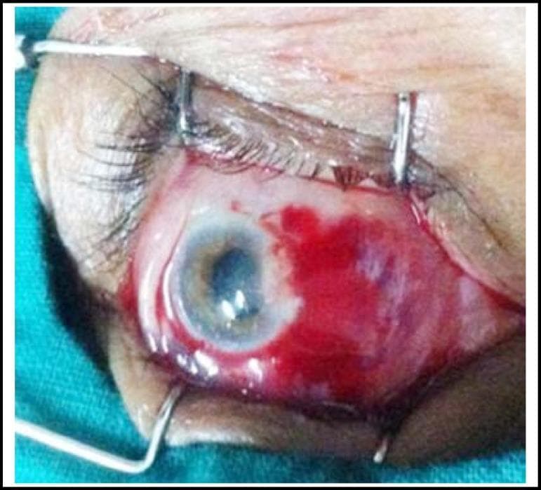 This clinical photograph captures an intraoperative view of an ophthalmic surgical procedure, specifically a pterygium excision using the 'bare sclera' technique. The eye is held open by metal eyelid speculums (retractors). On the nasal side of the cornea, the conjunctiva has been surgically removed, leaving a rectangular area of exposed, bare white sclera. This surgical bed exhibits localized subconjunctival hemorrhage and pooling of crimson blood, which is characteristic of the immediate post-excision phase. The cornea shows a focal area of mild superior haze at the previous site of the pterygium head, while the remainder of the corneal surface and the pupil appear relatively clear and intact. This image demonstrates a critical step in pterygium surgery prior to the application of adjuvant therapies like Mitomycin C (MMC) or the placement of a conjunctival autograft to reduce the risk of recurrence. The clinical focus is on the preparation of the scleral bed and management of the surgical site.