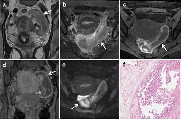 This composite educational resource presents diagnostic imaging and histopathology of a tubal ectopic pregnancy in a 44-year-old female. (a, b) Coronal and axial T2-weighted MR images show a distended, predominantly hypointense sac-like cystic mass in the left pelvic cul-de-sac. (c, d) Axial and coronal fat-suppressed T1-weighted images reveal low-to-intermediate signal intensity within the tubal lumen and a characteristically hyperintense, thickened wall, signifying hematosalpinx. (e) An axial diffusion-weighted image (DWI, b=800 s/mm²) demonstrates restricted diffusion within the lesion, indicated by high signal intensity. The MRI series also highlights the absence of an intrauterine gestational sac. (f) Corresponding light microscopy (H&E stain, 200x) provides histopathological confirmation, showing chorionic villi embedded within the fallopian tube wall. This case illustrates the multi-parametric MRI features of ectopic pregnancy, including hematosalpinx and restricted diffusion, which are critical for differentiating adnexal masses in patients with elevated β-hCG and acute abdominal pain.