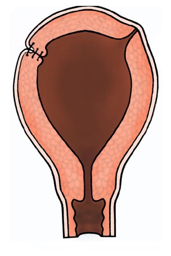 This medical illustration depicts a coronal cross-section of a human uterus, highlighting a surgical repair of the uterine wall. The organ is shown with its characteristic pear-shaped anatomy, including the fundus, body, and cervical canal. The uterine wall is stratified into three distinct layers: an outer perimetrium (serosa), a thick middle myometrium with a textured appearance, and a dark internal endometrial cavity. On the upper left aspect, specifically in the region of the uterine cornu, several dark, transverse inverting sutures are visible. These represent superficial polypropylene (Prolene) sutures applied to the serosal layer. The illustration demonstrates a post-operative state where the sutures serve to appose the seromuscular layers, promoting hemostasis and preventing the formation of peritoneal adhesions or fibrosis following surgical reconstruction. This diagram is utilized in obstetrics and gynecology to explain surgical techniques for managing myometrial weakness, cornual ectopic pregnancies, or uterine rupture repair.