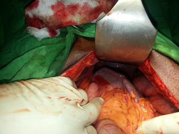 An intraoperative clinical photograph showing a surgical field during an exploratory laparotomy or abdominal procedure. The image displays the anatomical relationship between the spleen and the left colic flexure (splenic flexure) situated beneath the left diaphragmatic dome. A large metallic surgical retractor is positioned superiorly to provide exposure. Within the incision, lobulated orange-yellow adipose tissue (omentum) is prominent, adjacent to the reddish-purple smooth surface of the spleen and sections of the large intestine. A gloved hand is shown manipulating the visceral structures for inspection. The periphery includes green surgical drapes and blood-stained gauze sponges. This visual demonstrates the surgical anatomy of the upper left abdominal quadrant, relevant for cases involving pneumoperitoneum or diaphragmatic elevation of abdominal viscera.