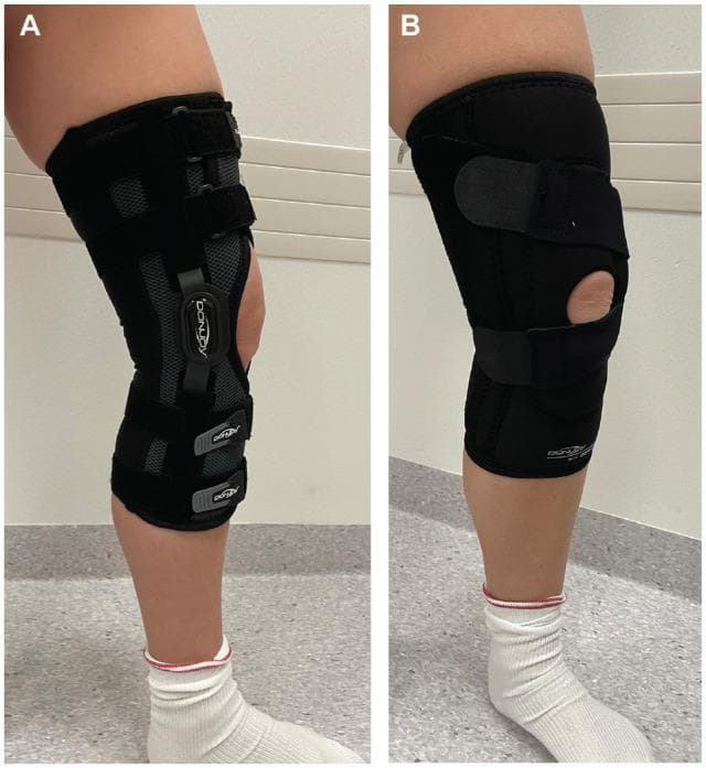 A side-by-side clinical photograph comparison of two different types of knee orthoses used in orthopedic rehabilitation, specifically for traumatic patellar dislocation. Image A displays a hinged, patella-stabilizing, motion-restricting knee brace. This device features a rigid frame with integrated lateral hinges designed to limit the range of motion (ROM) to a controlled 0° to 30° flexion arc. It is secured with multiple circumferential hook-and-loop straps and semi-rigid components for high-level support and immobilization. Image B shows a non-hinged, soft neoprene sleeve brace. This design includes a circular patellar cutout and adjustable straps for localized compression and proprioceptive feedback, but lacks rigid mechanical hinges, thereby allowing for a full range of motion. The images demonstrate the contrast between a restrictive bracing strategy aimed at limiting joint stress during acute healing and a non-stabilizing compression strategy focused on comfort and mobility. Both braces are shown applied to the right knee of a patient in a clinical setting.