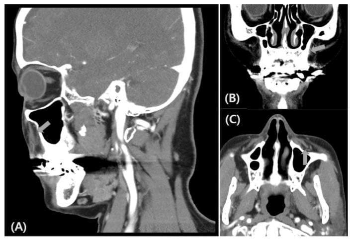 This diagnostic image set consists of three facial Computed Tomography (CT) scans presented in sagittal (A), coronal (B), and axial (C) planes. The images focus on the midface anatomy, specifically the maxillary and orbital regions. In the sagittal view (A), the eye, maxillary sinus, and anterior facial soft tissues are visible. The coronal view (B) highlights the nasal septum, turbinates, and the floor of the orbits. The axial view (C) demonstrates the transverse anatomy of the maxillary sinuses and the nasal cavity. Grey arrows in all three panels denote the anatomical location and course of the infraorbital nerve (ION) as it exits the infraorbital foramen. The scans are postoperative, following the removal of foreign body implants that were previously located near the maxillary sinuses. There is an absence of hyperdense foreign material or artifacts in the vicinity of the ION, indicating successful surgical clearance. These images serve as an educational resource for identifying the spatial relationship between the infraorbital nerve and the surrounding sinonasal and orbital bony structures in multi-planar imaging.