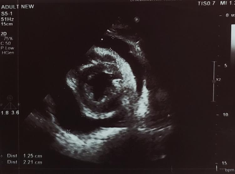 A 2D transthoracic echocardiogram in the parasternal short-axis view demonstrating a significant pericardial effusion. The diagnostic image shows a large, circumferential anechoic (echo-free) space between the parietal pericardium and the visceral pericardium (epicardium), indicating fluid accumulation around the myocardium. Electronic calipers and distance markers are visible, quantifying the thickness of the effusion at two points: 1.25 cm and 2.21 cm. The myocardium appears as a homogenous echogenic structure, and there is no visible evidence of internal echoes or fibrin strands within the fluid space. The pericardium presents as a bright, hyperechoic boundary. This clinical imaging finding is representative of a large pericardial effusion, which carries a risk of progression to cardiac tamponade. Key educational concepts include ultrasound diagnosis of pericardial disease and the quantification of pericardial fluid volume.