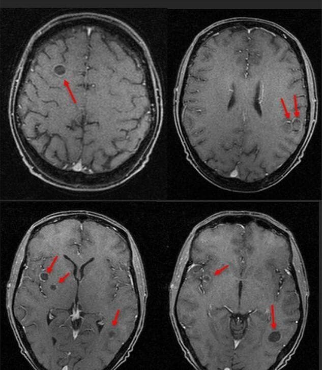This diagnostic image displays four axial slices of a T1-weighted contrast-enhanced MRI of the brain, demonstrating multifocal intracranial lesions consistent with brain abscesses. The lesions, highlighted by red arrows, are characterized by well-circumscribed, ring-enhancing morphology with hypointense central cores, suggesting liquefactive necrosis or purulent material. The distribution is widespread and asymmetric across both hemispheres, involving the right frontal lobe, right para-ganglionic region, and bilateral temporal lobes. The presence of multiple lesions in different vascular territories is clinically significant for hematogenous dissemination, often secondary to an extracranial source of infection such as a hepatic abscess or bacteremia (e.g., Streptococcus intermedius). This image serves as a teaching tool for recognizing the radiologic presentation of septic emboli and intracranial suppuration in the context of systemic infection and new-onset seizures.