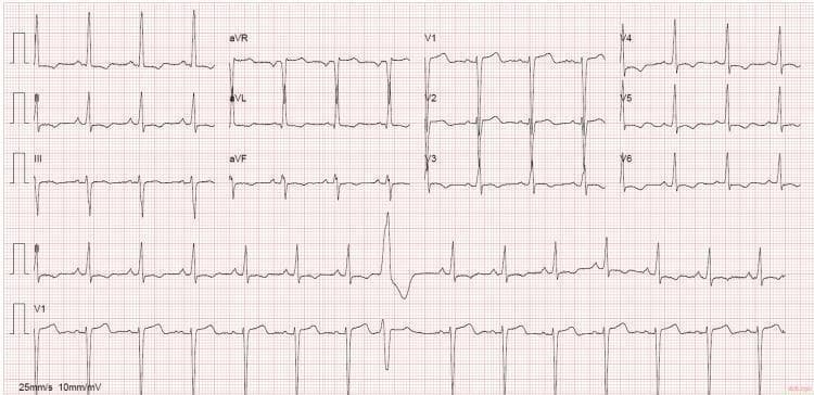 A 12-lead electrocardiogram (ECG) printed on standard grid paper (25 mm/s, 10 mm/mV) showing a baseline sinus rhythm with a notable single premature ventricular contraction (PVC). The PVC is characterized by a wide, bizarre QRS complex followed by a compensatory pause, most clearly visible in the long rhythm strip at the bottom. Across the precordial leads, specifically V4 through V6, there is evidence of ventricular repolarization abnormalities, including ST-segment depression and T-wave inversion. These findings are clinically suggestive of left ventricular overload or myocardial ischemia. The QRS axis appears normal to slightly leftward, and the rhythm strip at the bottom (lead II and V1) confirms a regular underlying rate disrupted by the ectopic beat. This diagnostic image is significant for evaluating hypertensive heart disease, cardiomyopathy, or ischemic cardiac events in a clinical setting.