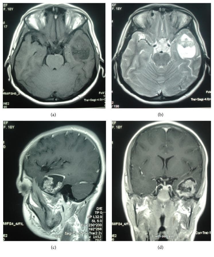 Diagnostic imaging series of a brain MRI displaying a papillary craniopharyngioma located in the left temporal lobe. The four-panel figure includes: (a) axial T1-weighted image showing a relatively hypointense, heterogeneous mass; (b) axial T2-weighted image revealing a well-defined solid-cystic lesion with high-signal cystic components and no significant surrounding vasogenic edema; (c) sagittal and (d) coronal gadolinium contrast-enhanced T1-weighted images. These post-contrast views highlight a distinct peripheral rim of enhancement around the cystic portion and nodular enhancement within the solid component. Notably, the tumor appears isolated in the temporal lobe without typical connection to the suprasellar or intrasellar regions. This case serves as a neuroimaging example of an ectopic craniopharyngioma, demonstrating its characteristic mixed composition and enhancement pattern for use in neuroradiology education and differential diagnosis of temporal lobe masses.