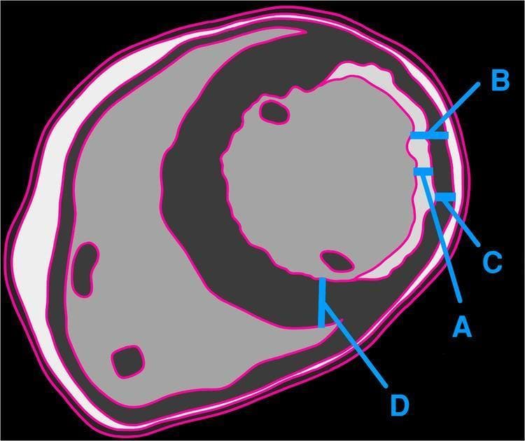 A cross-sectional anatomical diagram illustrating the quantification of myocardial viability and remodeling following chronic infarction. The image depicts a transverse slice of the heart with specialized labeling of myocardial layers. Segment A represents the area of late gadolinium enhancement (LGE) or fibrosis, appearing as a light grey/white subendocardial layer. Segment B shows the full transmural thickness of the remodeled, thinned myocardium. Segment C highlights the remaining non-enhancing, viable myocardium in the infarcted zone. Segment D serves as a control, representing the full thickness of adjacent healthy, non-remodeled myocardium. The diagram contrasts two methodologies for surgical candidacy: the traditional approach (C/B ratio) versus the authors' proposed approach (C/D ratio) for assessing transmurality. The use of different grey scales and blue calipers demonstrates the morphological changes associated with chronic myocardial thinning, providing a visual guide for risk stratification and determining viability prior to coronary artery bypass grafting (CABG).