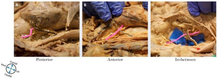 This clinical photograph sequence depicts anatomical dissections illustrating the surgical relationship between the recurrent laryngeal nerve (RLN) and the inferior thyroid artery (ITA), a critical landmark during thyroidectomy. The set consists of three panels labeled A, B, and C, with the RLN highlighted in pink for clarity. Panel A (Posterior) shows the RLN coursing posterior to the ITA trunk. Panel B (Anterior) shows the RLN crossing superficial (anterior) to the ITA. Panel C (In-between) demonstrates the nerve passing between the terminal branches of the ITA, with blue background material used to enhance visibility of the neural-vascular junction. Key surrounding anatomical structures labeled include the trachea (Tr), esophagus (Es), and thyroid gland (T). These images demonstrate anatomical variations essential for surgeons to identify to prevent iatrogenic nerve injury during endocrine neck surgery. The anatomical orientation is indicated by a directional compass showing cranial, caudal, medial, and lateral axes.