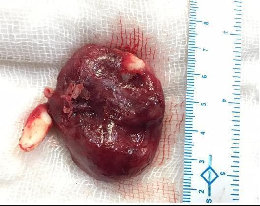 This clinical photograph shows a gross surgical specimen of an adenomatoid odontogenic tumor (AOT). The specimen is a thick-walled, spherical, and irregular cystic mass, approximately 5.5 cm in its longest dimension as indicated by the adjacent metric ruler. The tumor surface is smooth, slightly glistening, and exhibits a reddish-brown coloration suggestive of blood or fluid content. Pathognomonic for this type of odontogenic lesion, two unerupted teeth—specifically the left maxillary canine and the left upper lateral incisor—are seen firmly attached to the specimen. One tooth is embedded in the inferomedial portion, while the other is visible on the superior surface of the mass. The specimen's appearance reflects its origin from the maxillary sinus region, highlighting the follicular relationship between the tumor and impacted dental structures. This visual provides high-yield educational value for oral and maxillofacial pathology, illustrating the classic presentation of an intraosseous odontogenic neoplasm following enucleation.