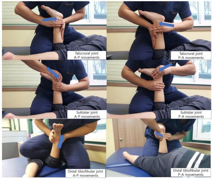 This clinical photographic series consists of six panels demonstrating manual joint mobilization techniques for the ankle complex, specifically targeting the talocrural, subtalar, and distal tibiofibular joints. The images depict a therapist performing both anterior-to-posterior (A-P) and posterior-to-anterior (P-A) glides on a patient in a supine position. The top row illustrates talocrural joint mobilization, focusing on the interface between the talus and the mortise to improve dorsiflexion and plantarflexion. The middle row displays subtalar joint mobilization, targeting the articulation between the talus and calcaneus. The bottom row demonstrates glides at the distal tibiofibular joint. Each panel features a blue directional arrow indicating the line of force applied by the therapist's hands, which are strategically placed to stabilize the proximal segment while mobilizing the distal bone. These techniques are characteristic of the Maitland manual therapy concept, frequently utilized in physical therapy to address joint hypomobility and improve range of motion in conditions like spastic diplegia or post-injury stiffness.