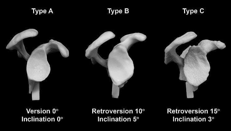 This comparative anatomical image displays three synthetic glenoid cast models representing Type A, Type B, and Type C morphologies according to the Walch classification of primary shoulder osteoarthritis. Each model is a 3D reconstruction based on clinical CT data, illustrating the progressive anatomical variations in version and inclination.
- Type A: Shows a neutral morphology with 0° of version and 0° of inclination, representing a balanced glenoid surface.
- Type B: Demonstrates 10° of retroversion and 5° of superior inclination, showing a visible posterior tilt and altered fossa orientation.
- Type C: Exhibits 15° of retroversion and 3° of inclination, characterized by a more pronounced posterior tilt and significant dysplasia.
The models include surrounding bony landmarks such as the scapular spine, acromion, and coracoid process, which serve as reference points for preoperative planning in total shoulder arthroplasty. This comparison is used in orthopedics to teach the visual assessment of glenoid bone loss and the necessary surgical correction angles required for implant positioning.