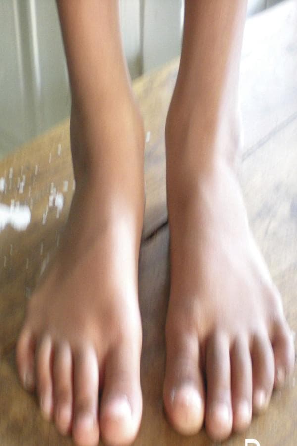 Clinical photograph showing an anterior (front) view of bilateral feet in a pediatric patient at a five-year follow-up for congenital clubfoot (talipes equinovarus) treatment. The image demonstrates the long-term anatomical outcome following corrective procedures, likely the Ponseti method. Residual findings include mild forefoot adduction bilaterally, where the forefoot curves inward toward the midline. The left foot exhibits a slightly more pronounced medial curvature of the lateral border compared to the right. Both feet display five well-formed digits without gross syndactyly or secondary skin lesions. The ankles appear slender with visible malleolar landmarks. The photograph serves as a clinical assessment of post-treatment alignment, focusing on the correction of the 'CAVE' components (cavus, adduction, varus, and equinus) associated with clubfoot deformity.