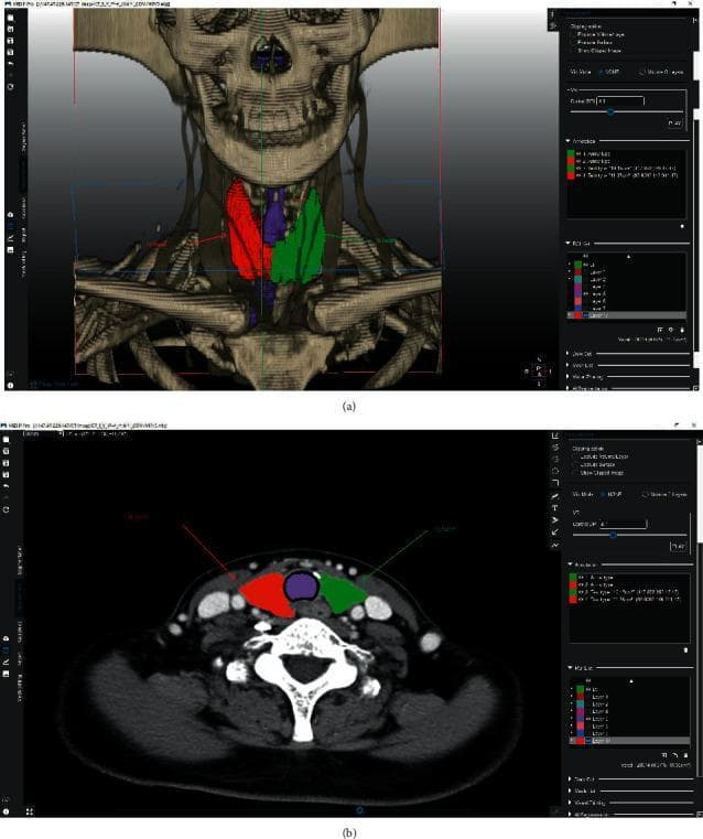 This medical visual demonstrates volumetric segmentation of the thyroid gland using specialized medical imaging software. Image (a) presents a 3D reconstruction overlay on a CT-derived skeletal model of the neck and upper thorax. The segmentation highlights the anatomical lobes: the right thyroid lobe is colored green, the left lobe is red, and the isthmus/central region is purple. Image (b) shows a corresponding axial CT slice at the level of the thyroid. In this cross-sectional view, the colored segmentation masks (red for left lobe, green for right lobe, and purple for the central isthmus) are superimposed on the soft tissue structures anterior to the trachea. The image illustrates the application of semi-automated graph-cut algorithms for preoperative planning in endocrine surgery, specifically for thyroid lobectomy. Key anatomical landmarks visible include the trachea, carotid arteries, jugular veins, and cervical vertebrae. This content is designed for intermediate to advanced medical training in radiology and surgical oncology, focusing on thyroid anatomy and computer-assisted volumetric measurement.