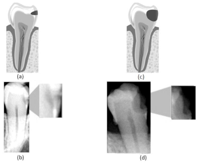 A multi-panel educational graphic illustrating dental caries progression through anatomical diagrams and diagnostic imaging. Panel (a) presents a cross-sectional anatomical diagram of a tooth showing an incipient caries lesion, depicted as a small dark area confined to the proximal enamel. Panel (b) shows a corresponding bitewing radiograph with an inset magnification, identifying a subtle radiolucency at the enamel surface, representing early-stage demineralization. Panel (c) is a diagram of an advanced caries lesion, showing a large dark area that has penetrated through the enamel and deeply into the dentin, approaching the pulp chamber. Panel (d) displays a clinical bitewing radiograph of an advanced lesion, where a significant, diffuse radiolucent area indicates extensive structural loss extending beyond the dentinoenamel junction. The composite image serves as a comparison chart for dental diagnostic training, highlighting the correlation between schematic disease models and radiological findings for both incipient and advanced interproximal caries.