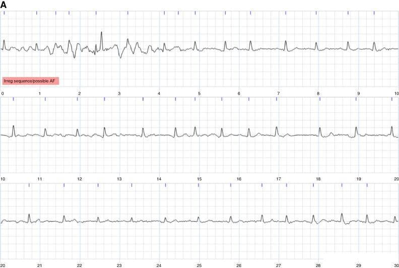 This diagnostic image displays a single-lead electrocardiogram (ECG) rhythm strip, divided into three continuous segments of 10 seconds each, totaling a 30-second recording. The first segment (0-10s) exhibits significant baseline wandering and disorganized electrical activity, characterized by erratic morphology that obscures distinct P waves and QRS complexes, which may represent artifact or severe arrhythmia. The subsequent segments (10-30s) demonstrate a more stable baseline with visible, narrow QRS complexes. However, the rhythm remains irregularly irregular with absent P waves, replaced by subtle fibrillatory waves in certain sections. A red annotation box labeled 'Irreg sequence/possible AF' highlights the clinical suspicion of Atrial Fibrillation. This image is used in medical education to illustrate the challenges of ECG interpretation, specifically differentiating between motion artifacts, uninterpretable signals, and pathological arrhythmias like Atrial Fibrillation or Atrial Tachycardia.