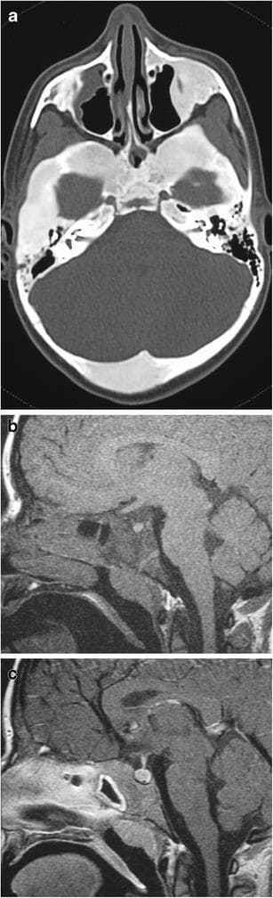 This composite educational image features three diagnostic views demonstrating polyostotic fibrous dysplasia in a pediatric patient with McCune-Albright syndrome. (a) Axial non-contrast CT scan of the skull showing classic 'ground glass' matrix within multiple expansile bony lesions, particularly involving the sphenoid and temporal bones, where normal marrow is replaced by fibro-osseous tissue. (b) Pre-contrast sagittal T1-weighted MRI illustrating significant expansion of the clivus with characteristic diffuse low signal intensity. (c) Post-contrast, fat-suppressed sagittal T1-weighted MRI demonstrating homogeneous, diffuse enhancement within the expanded clival lesion, indicating increased vascularity. The study highlights the imaging hallmarks used to identify fibrous dysplasia of the skull base, including skeletal expansion, hazy density on CT, and variable MRI signal patterns. This material is suitable for neuro-radiology education, focusing on craniofacial manifestations of systemic genetic disorders and the differentiation of fibro-osseous lesions.