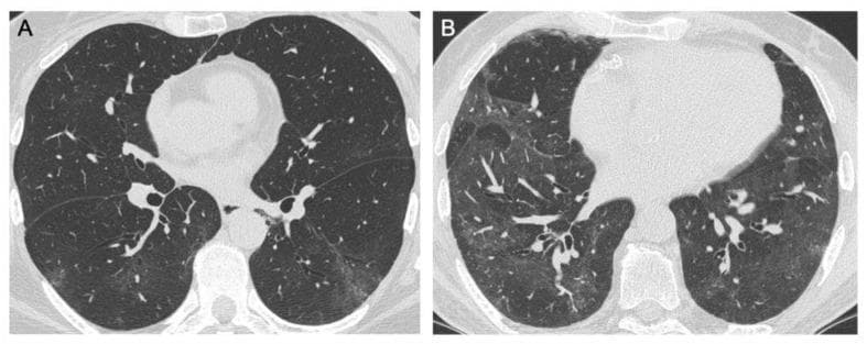 Two axial high-resolution computed tomography (HRCT) images of the thorax demonstrating patterns of interstitial lung disease, frequently associated with post-inflammatory sequelae such as those following viral pneumonia or ARDS. Image A shows bilateral, ill-defined subpleural ground-glass opacities (GGOs) primarily localized in the lower lobes. These GGOs represent a hazy increase in lung attenuation where underlying vascular structures remain visible. Image B illustrates a more diffuse distribution of ground-glass opacities across both lung fields. Associated findings include subtle interlobular septal thickening and fine reticular patterns, indicating mild interstitial involvement. No overt honeycombing, traction bronchiectasis, or dense consolidations are visualized in these specific slices. The images are pedagogically significant for distinguishing between focal subpleural and diffuse parenchymal opacification in the context of pulmonary follow-up and clinical assessment of lung parenchyma recovery.