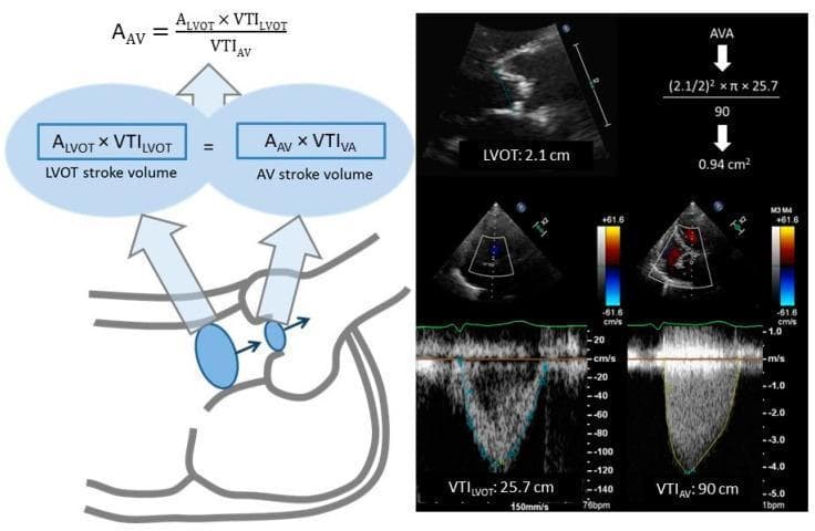 This educational graphic illustrates the continuity equation for calculating the aortic valve area (AVA) using echocardiography. On the left, a schematic diagram depicts the heart's left ventricular outflow tract (LVOT) and aortic valve (AV), emphasizing the conservation of mass where stroke volume at the LVOT equals stroke volume across the AV. On the right, various ultrasound modalities demonstrate data collection: a 2D transthoracic echo image measures the LVOT diameter (2.1 cm), while pulsed-wave and continuous-wave Doppler spectral curves calculate the velocity time integral (VTI) at both sites (VTILVOT = 25.7 cm and VTIAV = 90 cm). The mathematical application of these variables is shown at the top, resulting in an estimated AVA of 0.94 cm². This figure serves as a clinical guide for evaluating aortic stenosis severity by integrating anatomical measurements with hemodynamic flow parameters.