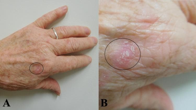 This clinical photograph consists of two panels (A and B) showing a biopsy-confirmed case of lichen simplex chronicus on the left dorsal hand of an elderly patient. Panel A provides a distant view, situating the lesion proximal to the second metacarpophalangeal joint. Panel B offers a close-up (macro) view for detailed morphological assessment. The lesion is a solitary, erythematous, circumscribed plaque approximately 14 x 10 mm in size, highlighted by a black oval. Key clinical features include prominent lichenification (thickening of the skin with exaggerated skin lines), surface scaling (whitish, fine scales), and ill-defined to moderately well-defined borders. The surrounding skin exhibits signs of chronological aging and actinic damage, including solar lentigines and fine rhytids. This image serves as an educational example of the classic presentation of a chronic eczematous process resulting from repeated scratching or rubbing, demonstrating the characteristic texture and color changes associated with lichen simplex chronicus in a common anatomical location.