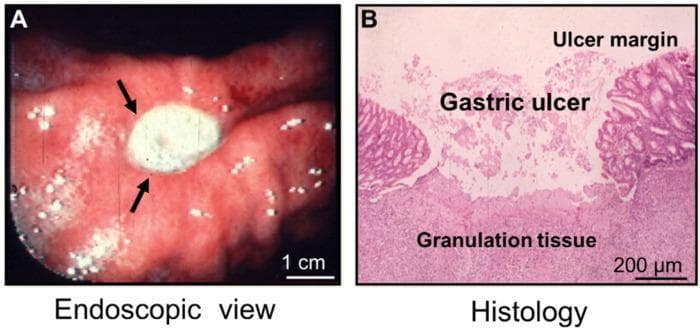 A composite image demonstrating gastric ulcer pathology through clinical imaging and microscopy. Panel A is an endoscopic photograph of a human stomach (lesser curvature), showing a well-demarcated, circular gastric ulcer (black arrows). The ulcer base is covered with opaque, white fibrinopurulent exudate, surrounded by hyperemic, erythematous mucosa with scattered whitish spots. Panel B is a histological section from an experimental model, stained with hematoxylin and eosin (H&E). The micrograph identifies three distinct pathological regions: the 'ulcer margin' with intact mucosal architecture; the central 'gastric ulcer' showing necrotic debris and loss of mucosal integrity; and the underlying 'granulation tissue' base, characterized by a dense layer of fibroblasts and proliferating microvessels. Scale bars indicate 1 cm for the endoscopic view and 200 µm for the histology. This comparison illustrates the clinical macroscopic appearance of a peptic ulcer alongside its microscopic structural components, highlighting the healing zone and the replacement of mucosa with connective tissue.
