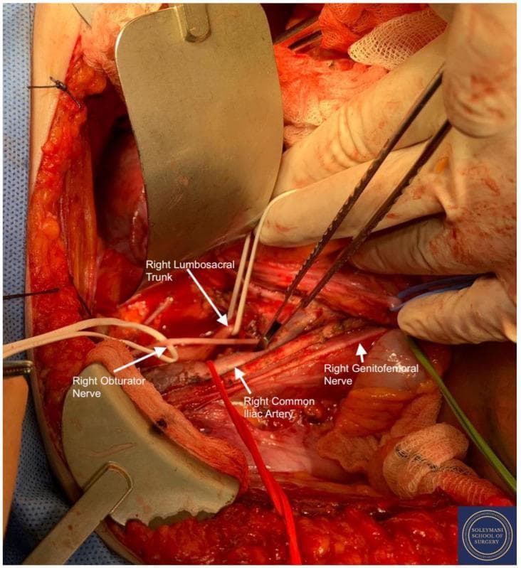 This clinical photograph shows a detailed intraoperative view of the right lumbosacral fossa during a complex pelvic surgical procedure (Total Mesometrial Resection). The image demonstrates the surgical isolation and slinging of key neurovascular structures for preservation and identification. The right common iliac artery is prominently identified with a red sling. Nervous system structures are precisely isolated using color-coded slings: the right genitofemoral nerve is marked with a green sling, the right lumbosacral trunk with an upper white sling, and the right obturator nerve with a lower white sling. The surgical field also reveals the deeper lumbar rami of the sacral plexus, including the L4, L5, S1, and S2 roots, and the proximal sciatic nerve. Retractors and forceps are used to provide exposure of the pelvic sidewall, illustrating the spatial relationships between the major iliac vasculature and the nerve plexuses relevant to oncological pelvic surgery. This visual serves as an educational reference for retroperitoneal pelvic anatomy and surgical navigation.