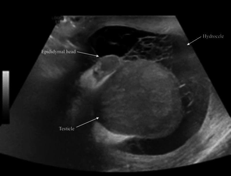 This diagnostic grayscale ultrasound image displays the scrotal contents of a patient with clinical features suggesting epididymo-orchitis. The image shows the testicle and the epididymal head, both of which exhibit a heterogeneous echotexture compared to normal, uniform testicular parenchyma. These variations in echogenicity are indicative of inflammatory changes or infection. Surrounding the testicular structures is a large, complex hydrocele. Unlike a simple hydrocele, which appears anechoic, this collection is characterized as 'complex' due to the presence of internal echoes and fine septations, which can represent fibrin strands, debris, or proteinaceous material resulting from an acute inflammatory process. The image is annotated with labels pointing to the 'Testicle', 'Epididymal head', and 'Hydrocele'. This visual is relevant for medical education concerning urological emergencies, scrotal imaging, and the sonographic differentiation between simple and complex fluid collections in the context of infection.