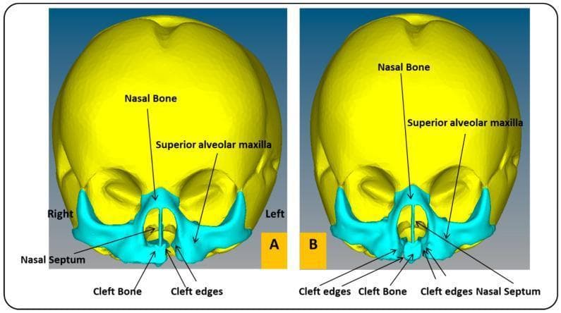 Frontal view of two Finite Element Analysis (FEA) skull models representing a one-month-old infant with craniofacial anomalies. Model A illustrates a Unilateral Cleft Lip and Palate (UCLP), showing a singular discontinuity in the superior alveolar maxilla and cleft bone on the left side, with a noticeable deviation of the nasal septum away from the cleft. Model B illustrates a Bilateral Cleft Lip and Palate (BCLP), characterized by two symmetrical clefts flanking a central prolabium/premaxillary segment (labeled as cleft bone). In the BCLP model, the nasal septum is centrally positioned but isolated by the bilateral voids. Both models use color-coding to differentiate anatomical regions: yellow for the neurocranium and teal for the midface/maxillary structures. Labeled landmarks include the nasal bone, superior alveolar maxilla, nasal septum, cleft bone, and cleft edges. These models are designed for biomechanical simulation of external pressure treatments to correct maxillary alignment in pediatric patients.