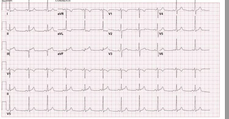 This diagnostic image is a 12-lead electrocardiogram (ECG) demonstrating signs of an acute inferior wall ST-elevation myocardial infarction (STEMI). The tracing reveals significant ST-segment elevation in the inferior leads (II, III, and aVF), with the elevation being most pronounced in lead III compared to lead II. Accompanying these changes is evidence of reciprocal ST-segment depression and T-wave inversion in the high lateral leads, specifically I and aVL. The precordial leads (V1-V6) show preserved R-wave progression without significant ST-segment deviations or QRS widening. The rhythm appears to be sinus bradycardia with a regular rate. This ECG is a classic representation of acute myocardial ischemia or infarction involving the territory of the right coronary artery (RCA). It serves as an educational tool for identifying inferior STEMI patterns, understanding reciprocal changes in lateral leads, and differentiating localized ST elevations from diffuse patterns.