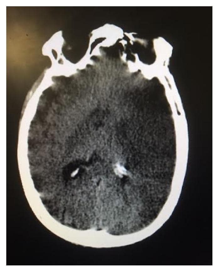 This diagnostic image is an axial non-contrast computed tomography (CT) scan of the brain, demonstrating features consistent with an acute ischemic event. The scan reveals a significant area of altered density within the left middle cerebral artery (MCA) territory. Specifically, there is a prominent focal hyperdensity within the proximal left MCA, often referred to as a 'hyperdense MCA sign,' which suggests acute arterial thromboembolism. Corresponding to this vascular finding, the brain parenchyma in the left hemisphere shows early signs of edema, characterized by subtle effacement of the cortical sulci and minimal compression of the left lateral ventricle's frontal horn. There is no evidence of intracranial hemorrhage or midline shift at this stage. This imaging is characteristic for evaluating hyperacute or acute ischemic stroke in a clinical setting, illustrating the early radiological indicators used for neurovascular assessment and triage for reperfusion therapies.