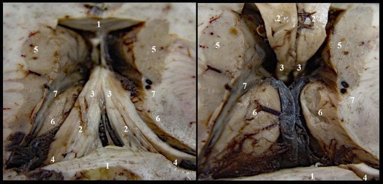 Anatomical Diagram/Clinical Photograph. This dual-panel image shows a high-magnification superior view of a human brain dissection, specifically focused on the neuroanatomical structures forming the roof of the third ventricle (Stage I denudation). Panel A (left) and Panel B (right) provide sequential perspectives of the deep cerebral anatomy. Key identified structures include: (1) the corpus callosum, (2) the body of the fornix, (3) the anterior pillars of the fornix, and (4) the posterior pillars of the fornix. The spatial relationship between the limbic system and basal ganglia is demonstrated by the lateral positioning of the (5) caudate nucleus and (6) thalamic nuclei relative to the midline fornix. Vascular and transitional markers (7) illustrate the optostriat sulcus and vein, lamina affixa, and tenia semicircularis. The dissection highlights the convergence of the fornix pillars towards the midline and their relationship to the superior surface of the thalamus, providing critical context for neurosurgical approaches to the third ventricle and understanding the complex white matter tracts in the periventricular region.