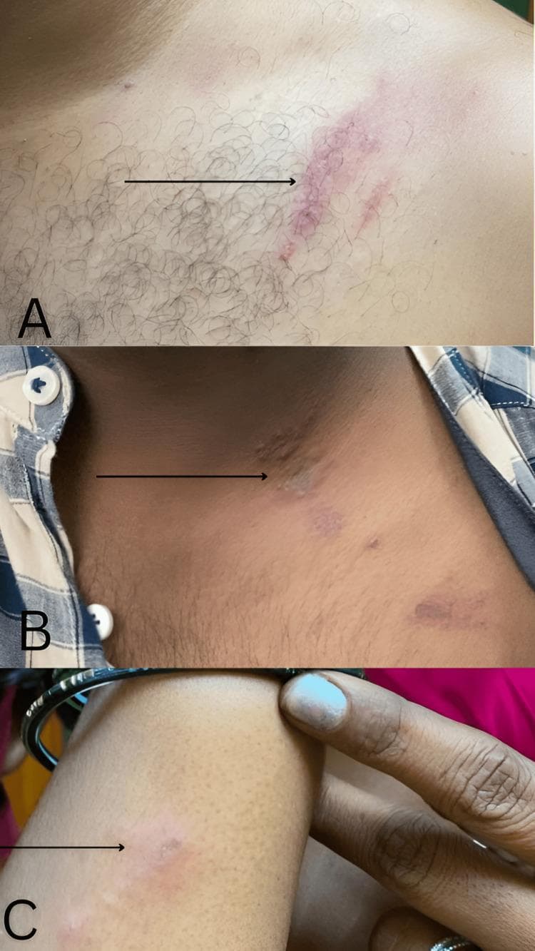 This composite clinical photograph displays three panels (A, B, and C) showcasing the characteristic dermatological manifestations of blister beetle dermatitis (Paederus dermatitis). Panel A illustrates a prominent linear erythematous plaque with overlying small vesicles on the left shoulder. Panel B focuses on the left lateral neck, demonstrating a similar linear grouping of discrete erythematous papules and plaques, with some exhibiting a necrotic central gray discoloration. Panel C shows a single, smaller circular erythematous lesion on the right forearm. The defining clinical feature across these images is the linear 'whiplash' or 'linearis' distribution, which occurs when the beetle is crushed or brushed against the skin, releasing the vesicant pederin. This presentation is a hallmark diagnostic sign for irritant contact dermatitis caused by certain Coleoptera species. The educational focus is on identifying linear inflammatory patterns and distinguishing them from allergic contact dermatitis or herpes zoster based on morphology and historical exposure to insect irritants.