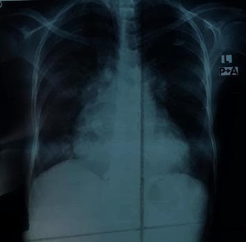 Posteroanterior (PA) view chest X-ray demonstrating clinical features of congestive heart failure and pulmonary edema. The image shows significant cardiomegaly with an enlarged cardiac silhouette. There is evidence of pulmonary venous hypertension, specifically characterized by upper lobe diversion where the vascular markings in the upper lobes are more prominent than those in the lower zones. The hilar regions appear congested with increased density and blurring of the hilar shadows. In the lower lung fields, patchy opacities and areas of increased density are visible, consistent with pulmonary consolidation or alveolar edema. The diaphragmatic angles appear somewhat obscured by the parenchymal density changes. This radiographic presentation is typical for decompensated heart failure, illustrating the redistribution of blood flow and fluid accumulation within the pulmonary parenchyma.