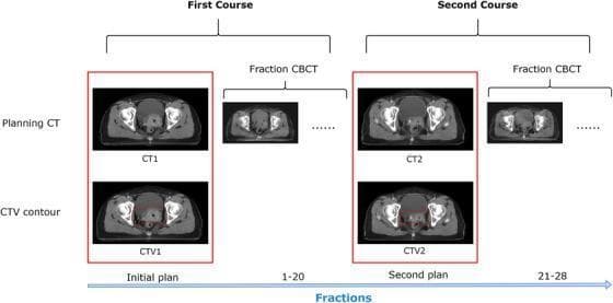This medical schematic illustrates a two-course radiotherapy data acquisition protocol for cervical cancer, highlighting the relationship between planning CTs and inter-fractional imaging. The diagram is divided into 'First Course' and 'Second Course' sections along a chronological 'Fractions' timeline. For each course, axial CT images of the female pelvis are shown. The first row displays the 'Planning CT' (labeled CT1 and CT2) used for initial dose calculation. The second row displays corresponding 'CTV contour' images (labeled CTV1 and CTV2), featuring a red outline superimposed on the anatomy to delineate the Clinical Target Volume (CTV), which includes the primary tumor, uterus, and regional pelvic lymph nodes. To the right of each planning phase, smaller 'Fraction CBCT' (Cone Beam CT) images represent daily imaging sessions (fractions 1-20 for the first course and 21-28 for the second). The diagram demonstrates the clinical workflow for adaptive radiotherapy, where a second planning CT is acquired mid-treatment to account for anatomical changes and tumor shrinkage.