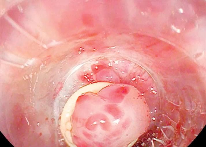 This diagnostic image is an endoscopic view of a band ligation procedure for esophageal varices. The photograph shows a clear, cylindrical banding cap placed directly over a protruding varix in the lower third of the esophagus. The varix appears as a swollen, pinkish-red mass with visible 'red signs' (cherry red spots), indicating a high risk of hemorrhage. The banding cap's rim is visible as a white circular edge, used to provide suction and facilitate the mechanical ligation of the varix. Surrounding the cap, the esophageal mucosa is erythematous and slightly edematous with some blood-tinged fluid present, consistent with recent instrumentation or oozing. This clinical photograph demonstrates the 'band-on-band' technique in gastroenterology, used to secure a suboptimal initial ligation. The primary educational focus is the visual identification of large-caliber esophageal varices and the corrective positioning of endoscopic variceal ligation (EVL) equipment in the management of portal hypertension complications.
