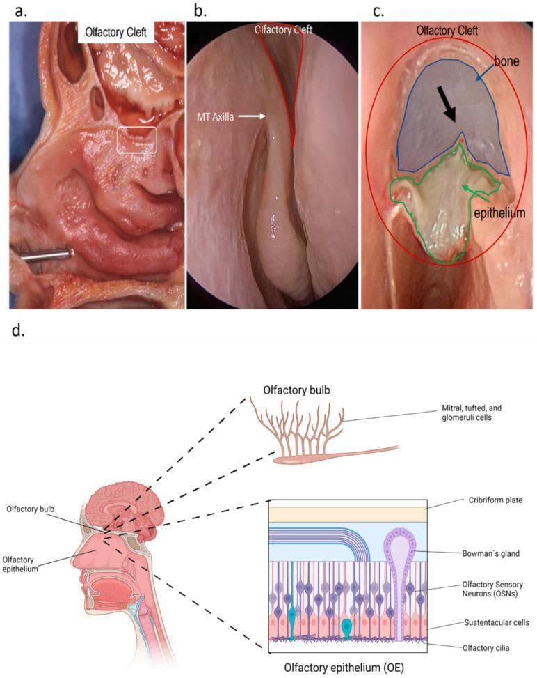 This composite educational graphic illustrates the anatomy and histology of the human olfactory system. Figure (a) is a sagittal anatomical specimen showing the olfactory cleft in the cranial nasal cavity. Figure (b) provides an endonasal endoscopic view of the olfactory cleft and the axilla of the middle turbinate (MT Axilla). Figure (c) displays a surgical or dissection view highlighting the relationship between the olfactory epithelium and the underlying bone, with a black arrow indicating the olfactory fibers. Figure (d) features a multi-level schematic: a sagittal head diagram showing the olfactory bulb's position, a zoomed histological view of the olfactory epithelium (OE), and a neural pathway diagram. The OE schematic identifies key cellular components: Olfactory Sensory Neurons (OSNs) with distal cilia, sustentacular cells, and basal cells, as well as Bowman’s glands and the cribriform plate. The neural diagram depicts OSN axons synapsing with mitral, tufted, and glomeruli cells in the olfactory bulb. This resource is designed for teaching the physiological structure and microanatomy of the human olfactory network.
