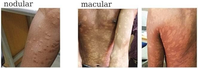 This set of clinical photographs illustrates the diverse dermatological manifestations of Post-Kala-Azar Dermal Leishmaniasis (PKDL). The visual content is divided into two primary morphological categories: nodular and macular. The 'nodular' image depicts multiple small, raised, skin-colored to erythematous bumps on the extensor surface of the forearm. The 'macular' images demonstrate a more extensive and diffuse distribution of pathology, characterized by flat, hypo-pigmented, or discolored patches. These macules are shown across several anatomical regions, including the chest, abdomen, forearms, and the posterior trunk (back and upper buttocks). The comparison highlights the variability in lesion morphology—ranging from discrete, elevated nodules to confluent, flat macules—that can occur following visceral leishmaniasis treatment. This educational material is relevant for tropical medicine and dermatology, specifically for the diagnosis and classification of Leishmania donovani-related skin sequelae.