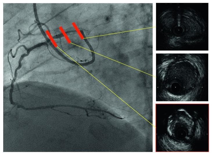 This composite diagnostic image features a coronary angiogram (left) alongside corresponding intravascular ultrasound (IVUS) cross-sections (right) of an anomalous right coronary artery (RCA). The angiogram displays a high-takeoff coronary artery with three red markers indicating the specific longitudinal segments analyzed via IVUS. The IVUS panels demonstrate diffuse, eccentric calcified plaque characterized by high-intensity echoic signals with posterior acoustic shadowing. Notably, the proximal intramural course of the ectopic artery exhibits an elliptical lumen shape, suggesting significant lateral compression from its position between the aorta and pulmonary artery. The cross-sectional views provide critical detail on vessel morphology, showing non-circular deformation and the burden of atherosclerotic plaque that is not fully captured by luminography alone. This material is designed for advanced cardiovascular training, illustrating the diagnostic utility of IVUS in assessing anatomical anomalies and plaque composition during percutaneous coronary intervention (PCI).