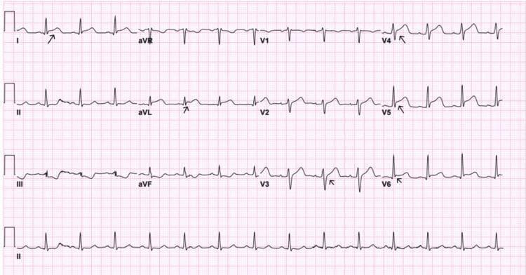 This diagnostic image is a 12-lead electrocardiogram (ECG) showing findings on day zero post-percutaneous coronary intervention (PCI) for an acute anterior wall myocardial infarction. The ECG demonstrates a sinus rhythm with persistent ST-segment elevation in the high lateral leads (I, aVL) and across the precordial leads (V3 through V6). Arrows highlight specific areas of ST-segment elevation and T-wave morphology. The precordial leads show a progression of the QRS complex with visible elevation relative to the isoelectric line, though resolving from previous shark-fin morphology. Leads V1 and V2 exhibit a right bundle branch block (RBBB) pattern, characterized by an rSR' configuration. There is also evidence of reciprocal ST-segment depression in the inferior leads (II, III, and aVF). This ECG is clinically significant for monitoring post-reperfusion status and identifying residual ischemia or evolving infarction patterns in the anterior and lateral myocardial territories.