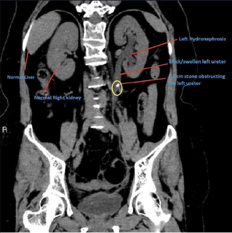 A diagnostic imaging study featuring a coronal CT scan of the abdomen and pelvis. The image highlights obstructive uropathy in the left urinary system. Key findings include a 1.2 cm hyperdense ureteral stone (highlighted by a yellow circle) located in the mid-to-proximal left ureter. Proximal to the obstruction, the left ureter exhibits significant dilation and wall thickening (hydroureter). The left kidney demonstrates moderate hydronephrosis, characterized by distention of the renal calyces and pelvis. In contrast, the right kidney, right ureter, and liver appear morphologically normal. Anatomical labels and text annotations clearly distinguish the pathological findings on the patient's left side from the normal anatomy on the right. This visual serves as a clear educational example of the upstream consequences of ureteral calculi, including secondary hydronephrosis and inflammatory ureteral changes, relevant for urology and emergency medicine curricula.