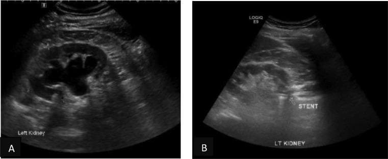 This dual-panel ultrasound image comparison illustrates the diagnostic and therapeutic monitoring of left-sided hydronephrosis. Panel (A) displays a grayscale ultrasound of the left kidney in a longitudinal plane, showing marked pelvicalyceal dilatation. The renal pelvis and calyces are distended with large, centrally located anechoic (fluid-filled) areas, characteristic of significant hydronephrosis. The renal parenchyma appears preserved but displaced peripherally by the dilated collecting system. Panel (B) shows a follow-up ultrasound of the same kidney following the insertion of a Memokath ureteric stent. There is a prominent reduction in the distension of the renal pelvis and calyces, indicating resolution of the hydronephrosis. A highly echogenic, linear structure with acoustic shadowing is visible within the renal pelvis/upper ureter region, labeled as 'STENT'. This educational comparison demonstrates the effectiveness of internal drainage in relieving upper urinary tract obstruction caused by ureteric strictures. The image is relevant for urology and radiology trainees focusing on renal imaging and interventional urology outcomes.