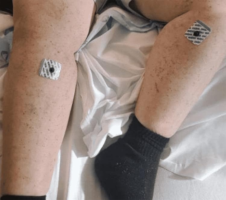 Clinical photograph of the bilateral lower extremities of a 47-year-old female, illustrating the resolving phase of a maculopapular rash, diagnosed as adult-onset IgA vasculitis (Henoch-Schönlein purpura). The skin shows a diffuse distribution of residual erythematous macules and small papules, primarily located on the shins and lower thighs. Some lesions exhibit post-inflammatory hyperpigmentation, indicating healing. Two square ECG/monitoring adhesive electrode patches are visible: one on the right lower thigh and one on the left shin. The patient is wearing a black compression-style sock on the left foot and ankle. This image serves as an educational example of the clinical progression and partial resolution of systemic vasculitis following corticosteroid treatment, highlighting the characteristic predilection for lower extremity involvement.