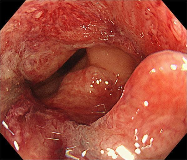 This clinical photograph is a pre-operative colonoscopy image of the rectum, demonstrating a type 2 advanced rectal adenocarcinoma. The endoscopic view shows a large, circumferential tumor mass that significantly narrows the rectal lumen. The lesion exhibits characteristic malignant features, including a reddish, hyperemic appearance, irregular surface texture with nodularity, and areas suggesting friability and contact bleeding. The tumor margins are raised and ill-defined, extending across almost the entire circumference of the rectal wall. This visual evidence of substantial luminal obstruction and tissue irregularity is consistent with a Borrmann type 2 (ulcerated-circumferential) morphologic classification, often associated with locally advanced colorectal cancer. The image serves as a key diagnostic tool for assessing tumor morphology, location relative to the anal verge, and the degree of luminal compromise prior to surgical intervention such as robotic low anterior resection.