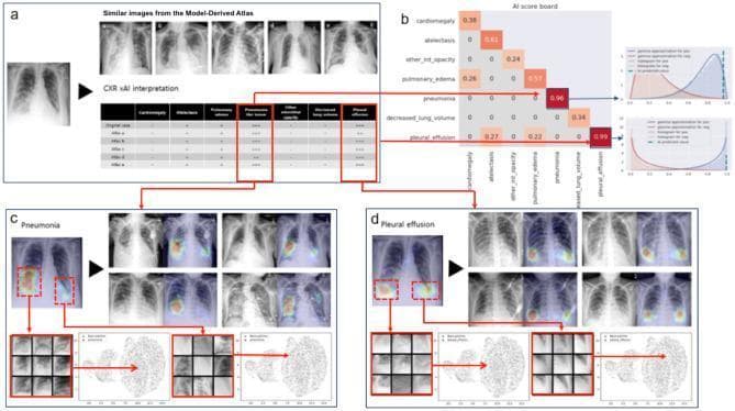 This infographic illustrates the workflow of an explainable Artificial Intelligence (xAI) system for chest X-ray (CXR) interpretation in respiratory infections. Section (a) displays a test CXR alongside similar images from a 'Model-Derived Atlas' and a probability table for various findings. Section (b) shows an 'AI scoreboard' quantifying confidence scores, highlighting high probabilities for pneumonia (0.96) and pleural effusion (0.99). Sections (c) and (d) provide visual evidence via Gradient-weighted Class Activation Mapping (Grad-CAM). For pneumonia (c), heat maps identify focal opacities in the lower lung fields. For pleural effusion (d), the Grad-CAM highlights the costophrenic angles, where blunting or increased density is visible. Both sections include UMAP dimensionality reduction plots and high-resolution feature patches, demonstrating how the model clusters the test image's pathological features with known reference cases from the atlas. The content is designed for intermediate to advanced medical imaging informatics, focusing on diagnostic transparency and lesion localization in radiology.