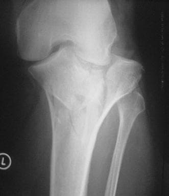 Anteroposterior (AP) pre-operative X-ray of the knee demonstrating a high-energy Schatzker type VI tibial plateau fracture. The diagnostic image shows a complex, comminuted fracture involving both the medial and lateral tibial condyles with significant disruption of the articular surface. A hallmark of the type VI classification is the complete dissociation between the tibial plateau (epiphysis/metaphysis) and the tibial shaft (diaphysis), visible here as multiple vertical and horizontal fracture lines extending through the proximal tibia. There is evident displacement of bone fragments and loss of joint congruity. Key landmarks including the distal femur and proximal fibula are visible, though the primary pathology is localized to the proximal tibia. This image is clinically significant for orthopedic surgical planning, highlighting the need for restoration of articular alignment and stable internal fixation in a multi-planar fracture pattern.