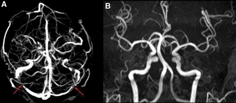This diagnostic image pair displays neurovascular imaging of a 39-year-old male. Image A is a 3D Time-of-Flight Magnetic Resonance Venography (TOF-MRV) reconstruction in an axial-oblique orientation. It highlights the intracranial venous drainage system, specifically pointing out flow void signals in the bilateral transverse sinuses (indicated by red arrows). This lack of expected signal in a TOF sequence may suggest venous sinus stenosis or thrombosis, correlating with clinical findings of idiopathic intracranial hypertension (IIH). Image B is a Time-of-Flight Magnetic Resonance Angiography (TOF-MRA) reconstruction focusing on the arterial circulation, including the Circle of Willis and its primary branches. This image demonstrates normal arterial blood flow with no evidence of significant stenosis, aneurysm, or vascular malformation. Together, these images serve to differentiate between venous outflow obstruction and arterial pathology in the context of elevated intracranial pressure.