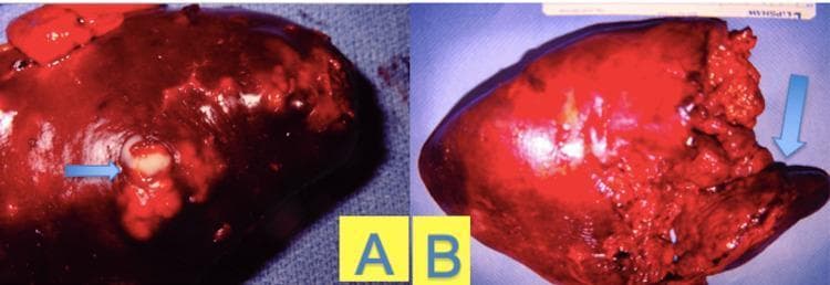 Gross pathology specimens of a human spleen demonstrating focal and diffuse features of a splenic abscess. Panel A displays a side-view of the dark-red, inflamed splenic capsule with a localized area of purulent exudate (pus formation), indicated by a blue arrow. The pus appears as a pale, off-white, viscous material extruding from a disrupted focal point on the diaphragmatic surface. Panel B shows the splenic parenchyma in a late stage of inflammation, characterized by a predominantly dark red and irregular surface. A blue arrow in Panel B points to a region of severe tissue disruption, consistent with necrosis and parenchymal liquefaction, where the normal splenic architecture is lost and replaced by amorphous, friable tissue. This comparison illustrates the progression from localized abscess formation to widespread inflammatory necrosis within the organ, relevant for surgical pathology and infectious disease education.