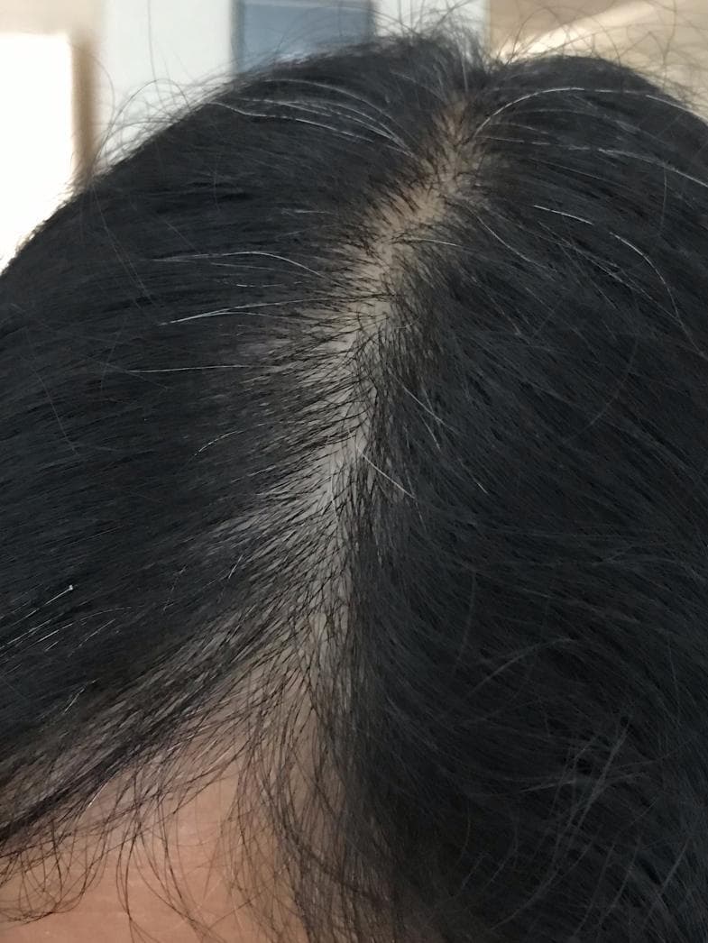 This clinical photograph shows a superior view of a human scalp and hair, demonstrating characteristic signs of female pattern hair loss (androgenetic alopecia). The primary clinical feature is a visible widening of the central part line, where there is a noticeable reduction in follicular density and thinning of hair shafts, leading to increased scalp exposure. The hair is predominantly dark with interspersed gray/white (canities) strands. The exposed scalp along the part line appears healthy, with a light skin tone and no immediate evidence of inflammation, scarring, or scaling. This visual presentation is typically used in dermatology to illustrate the progression of non-scarring alopecia and serves as a clinical reference for discussing treatment options, such as topical therapies or dietary supplements.